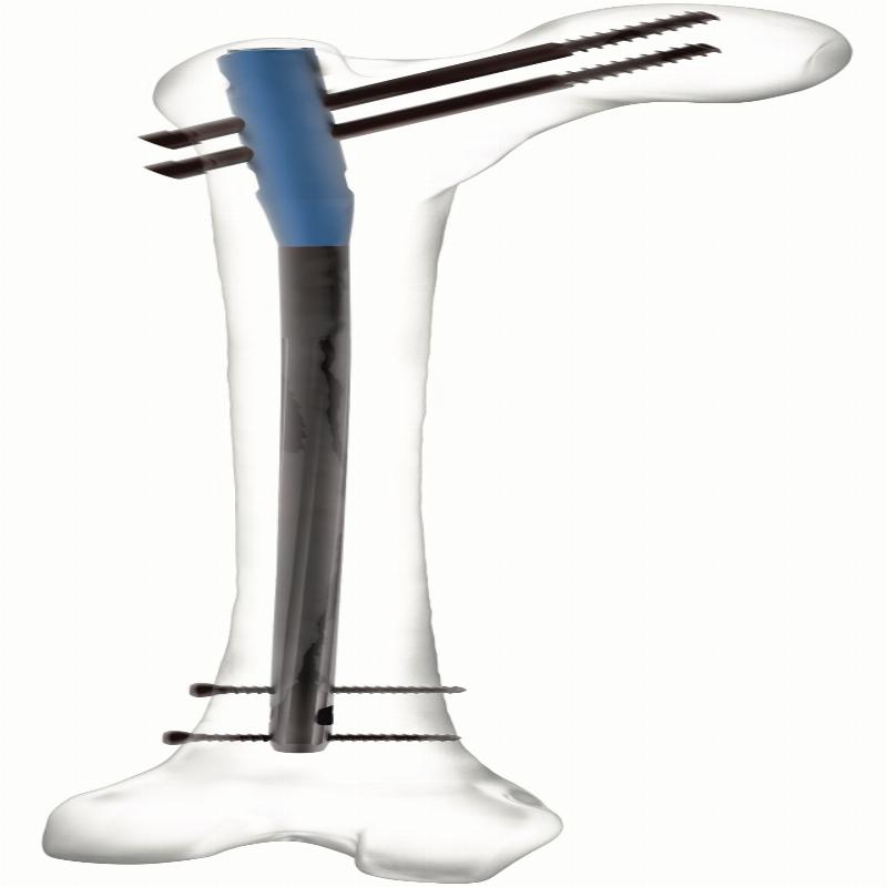 Auxein - Стегновий Стрижень Експерт